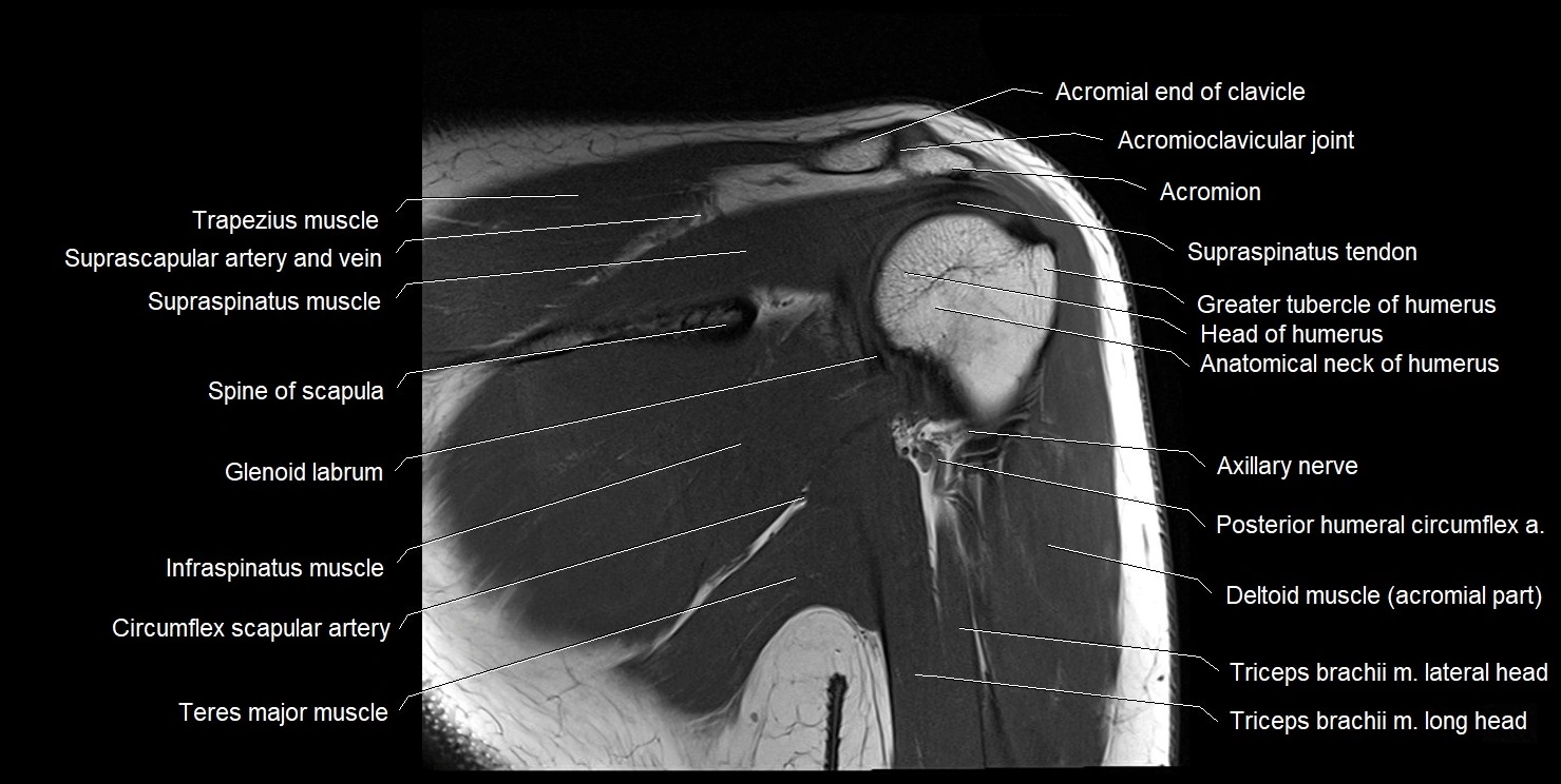 mri shoulder coronal cross sectional anatomy image 13.webp
